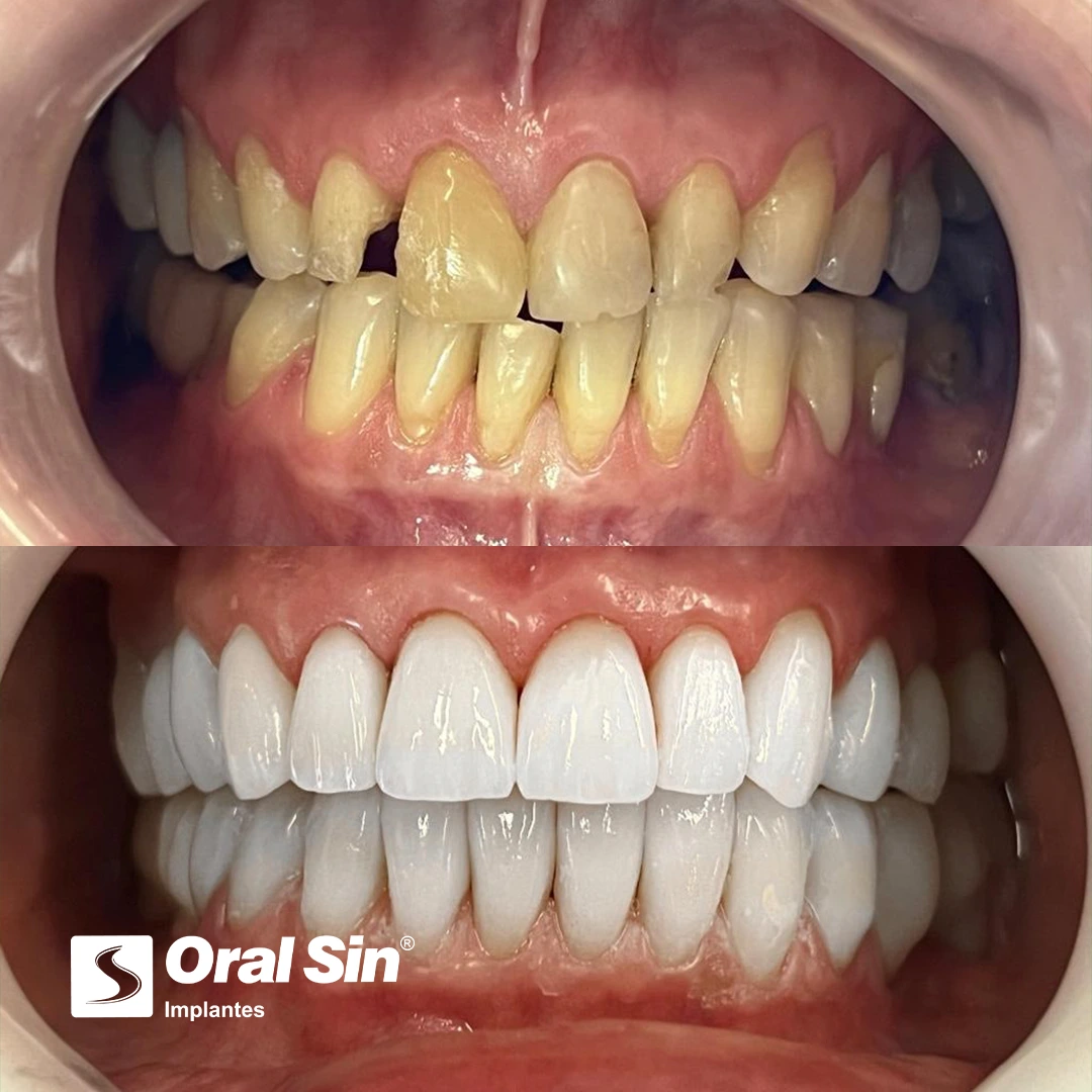 Antes-e-depois-facetas2.webp