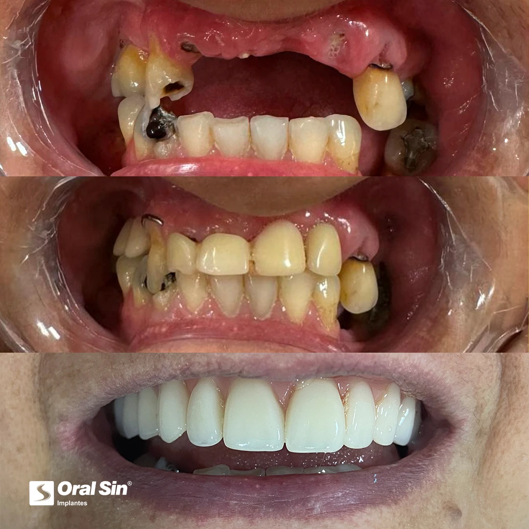 poa-sz-antes-e-depoispaciente-1.webp
